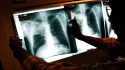 Three active tuberculosis cases reported in Maine as deadly disease continues to tick up across country